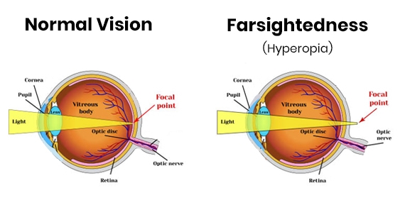 Hyperopia (Farsightedness) Symptoms, causes, diagnosis, treatment - LensePe