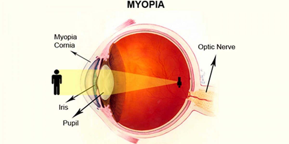 myopia-nearsightness-distance-vision-loss