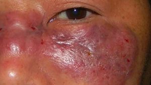 mucormycosis
